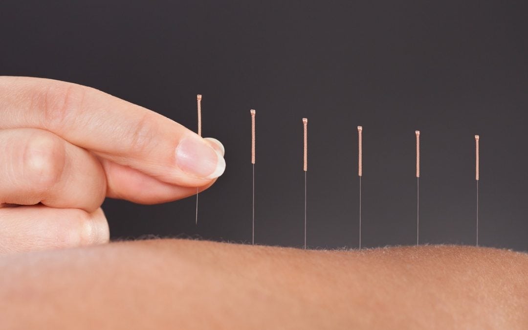 Could Acupuncture Work For You?